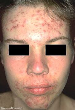 Acne vulgaris