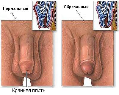 Нормальный и обрезанный половые члены