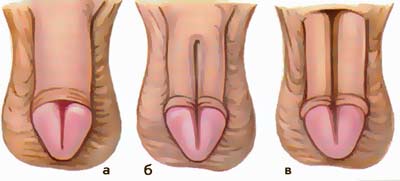 Различные формы эписпадии