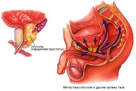 Опухоль простаты