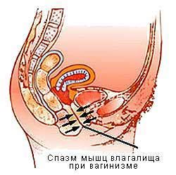 Спазм мышц влагалища при вагинизме