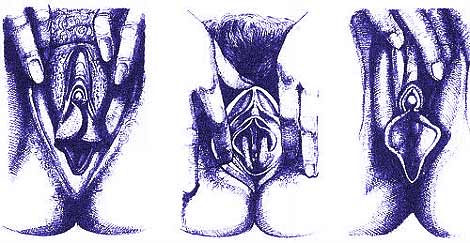 Варианты внешнего вида половых органов женщины
