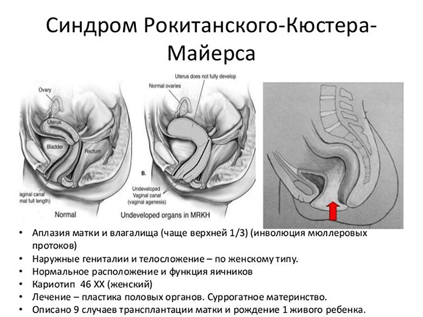 схема нормального строения половой системы женщины и аномалий в развитии гениталий, включая аплазию влагалища