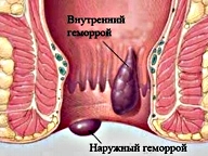 от геморроя